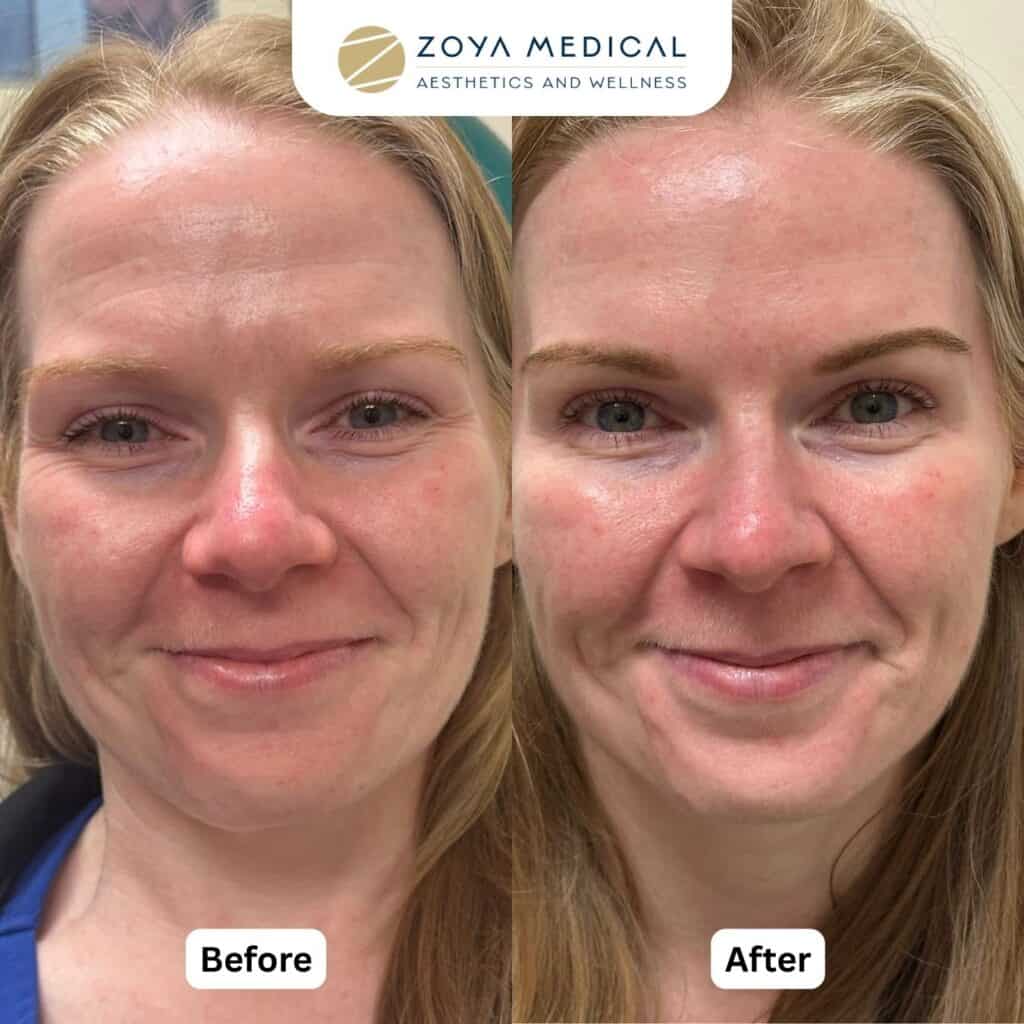 Botox in Orlando at Zoya Medspa