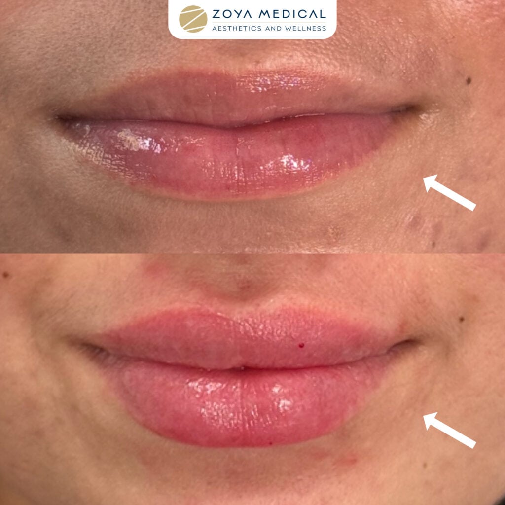 Botox Lip Fillers