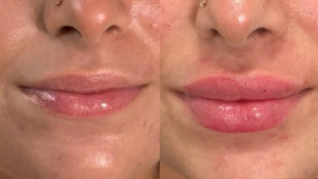Lip Fillers in Orlando